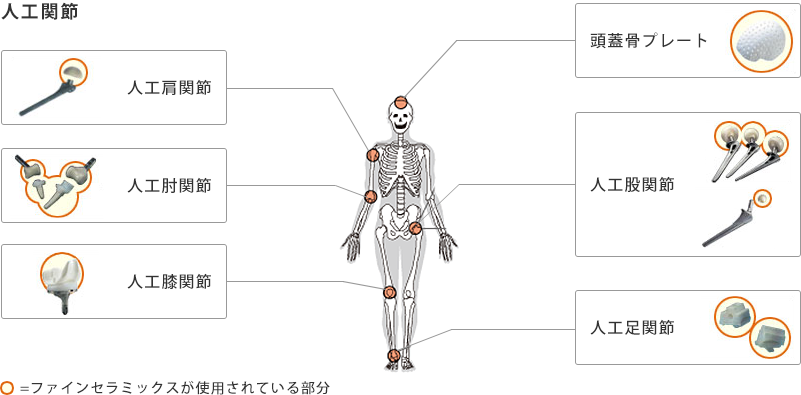 図：人工関節