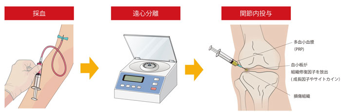 写真：PRP療法イメージ