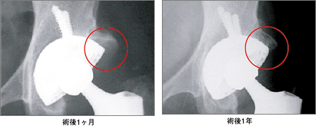 写真：術後1か月、術後1年