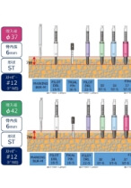 BL 術式チャート（ST 6㎜ストッパー付）