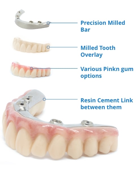Precision Milled Bar, Milled Tooth Overlay, Various Pinkn gum options, Resin Cement Link between them