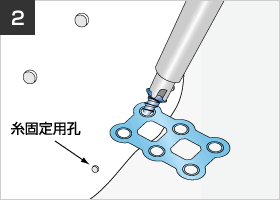 図：SKULPIO側にプレートを長さ4.5mmのスクリューを用いて手回しで固定します。