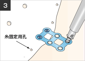 図：母床骨側には長さ4.0mmのスクリューを用いて固定します。