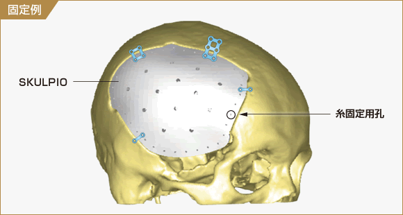 図：SKULPIO固定例