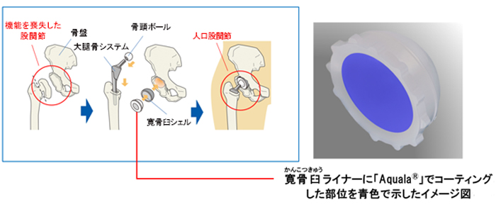 写真：人工股関節置換手術の仕組み